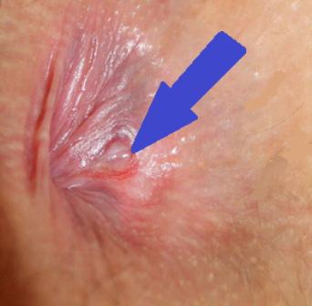 Treatment for Anal Fissures.