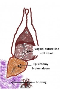 Episiotomy Broken Down
