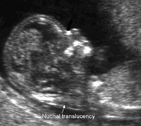 Nuchal Translucency scan – consider carefully first