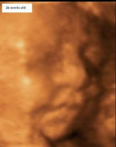 Size of Baby - 26 Week Scan