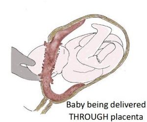 Two recent cases of placenta praevia