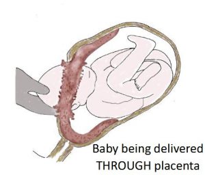 Baby Being Delivered Through Placenta