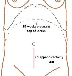 Appendicectomy Scar