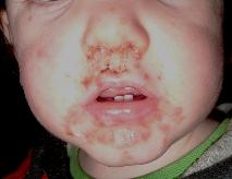 Hand Foot and Mouth Disease in Pregnancy