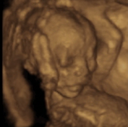 Morphology scan of the foetus