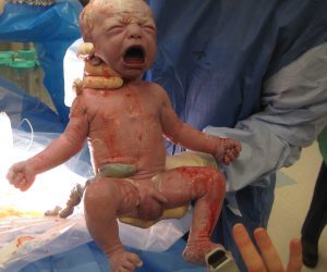 Caesarean section changes during my time as an obstetrician