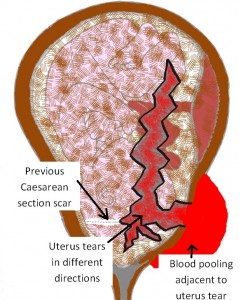 VBAC - Ruptured Uterus