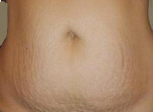 Skin and abdominal wall changes after childbirth