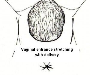 Vaginal Looseness Postnatally
