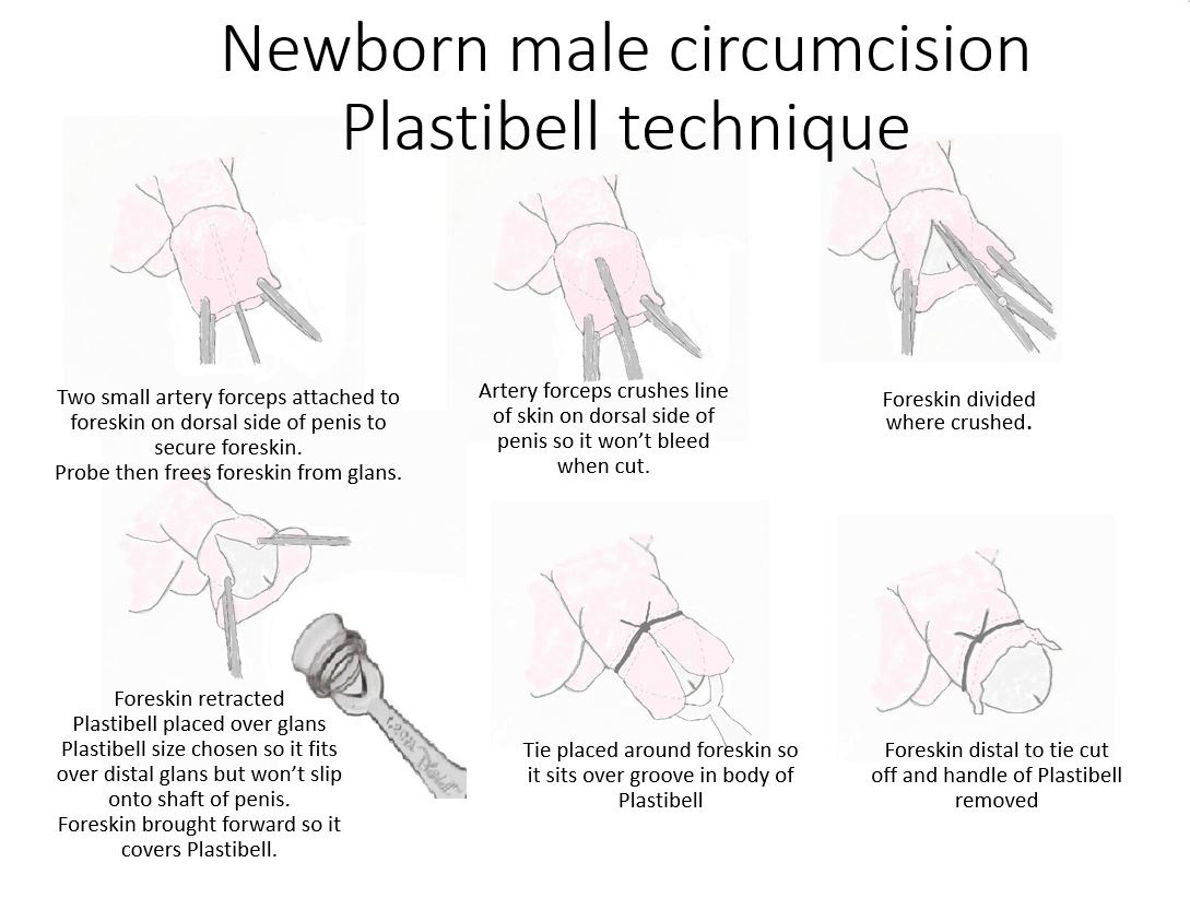 Male Circumcision - Plastibell Technique