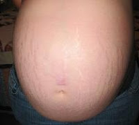 How can I stop getting stretch marks?