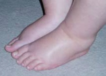 Swelling During Pregnancy