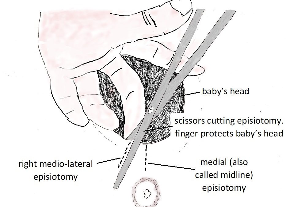 Will I need an episiotomy?