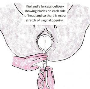 Kielland's Forceps Delivery