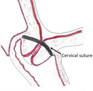 Cervical Suture