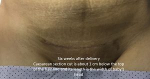 Caesarean Scar 6 Weeks After Delivery