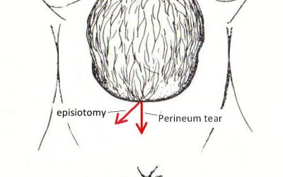 Perineum trauma with childbirth