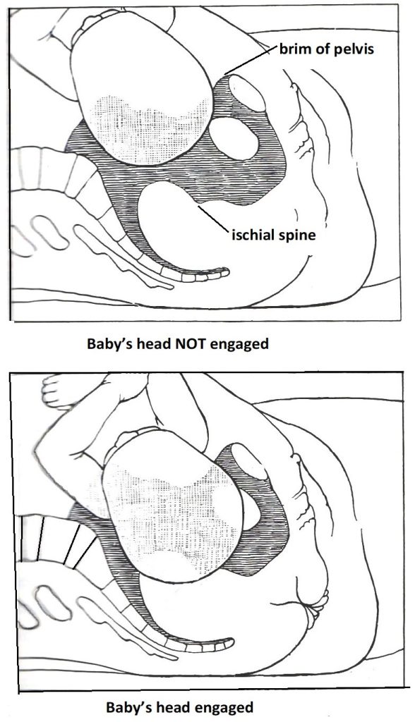 Diagram Showing Engagement of Baby's Head