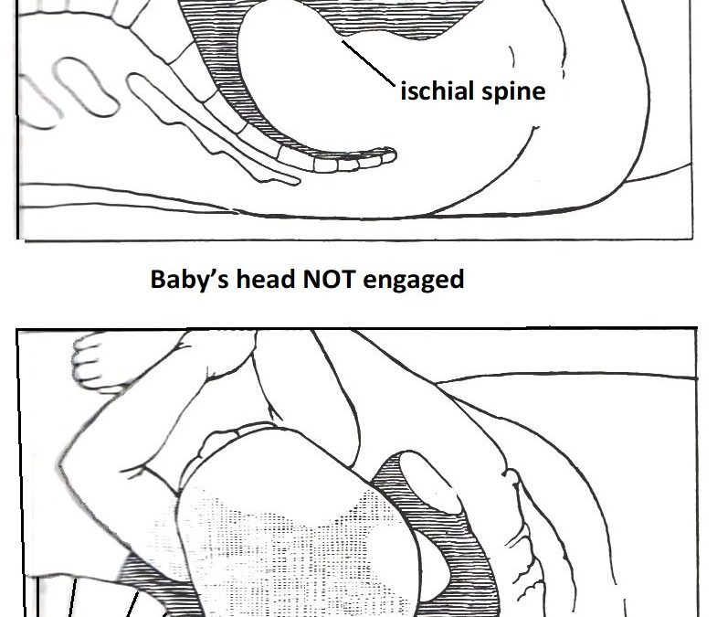 Baby’s head did not engage until in 2nd stage labour